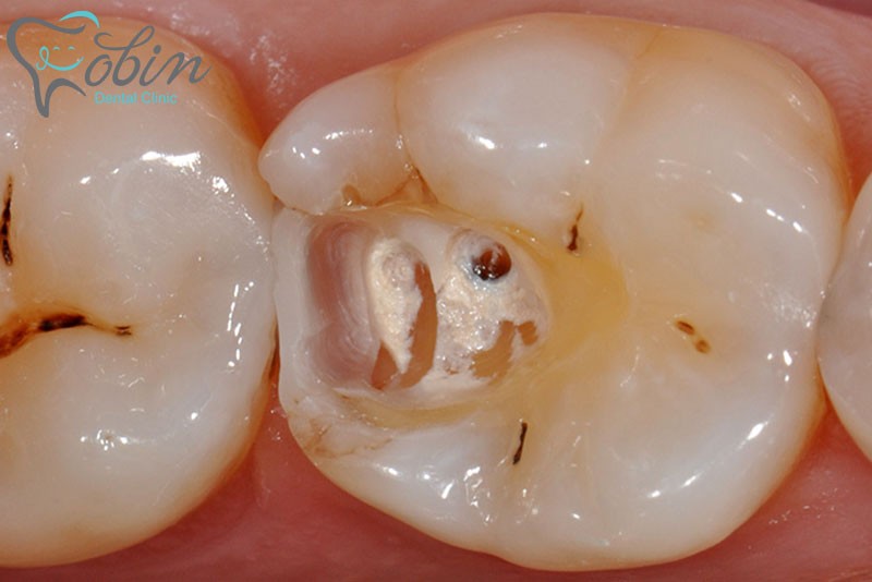 مواد کامپوزیت دندانی چه نوع موادی هستند؟